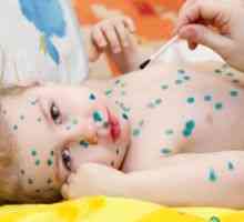 Cât de repede vindeca varicela la un copil acasa?