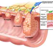 Cum de a vindeca adenocarcinom gastric?