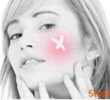 Cum se utilizează gropi de unguent de la acnee?