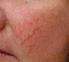 Cum de a trata acnee rozacee la domiciliu?