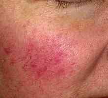 Cum de a trata rozacee sau acnee rozacee