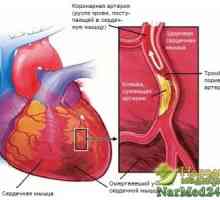 Cum de a trata Heart anginei folosind metode tradiționale