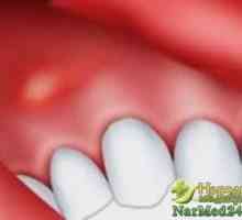 Cum de a trata o fistula asupra gingiilor - remedii populare și rețete