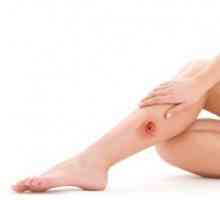 Cum de a trata rani pe picioare? Care sunt cauzele bolii?