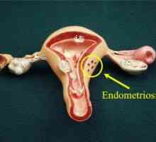 Cum de a identifica endometrioza si uterin vindeca? Luați în considerare toate opțiunile