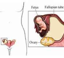 Cum de a identifica o sarcina extrauterina? Simptomele care pot fi identificate în casă