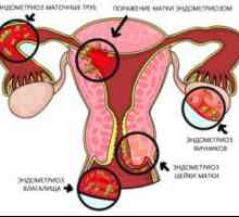 Cum să luați Janine endometrioza