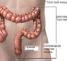 Procesul de inflamație de colon