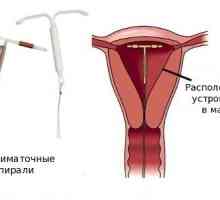 Cum este îndepărtarea unui dispozitiv intrauterin?