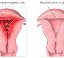 Cum să efectueze tratamentul hiperplaziei remedii populare endometriale?