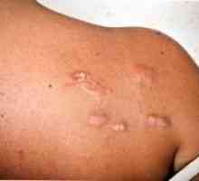 Cum sa recunoasca cicatrice coloidală: simptome și cauze ale bolii, metode de tratare