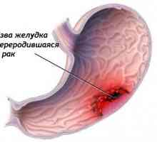 Metodele de tratament al cancerului gastric