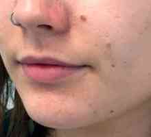Cum să se adapteze buzele cu ajutorul Botox