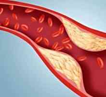 Cum de a reduce nivelul colesterolului din sânge