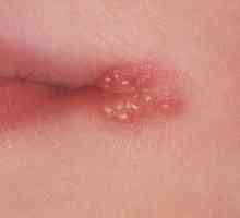 Cum de a vindeca leziuni herpetice pe buze repede acasă