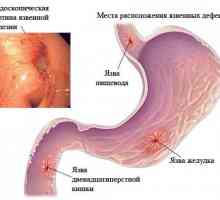 Cum de a vindeca ulcere ale esofagului?