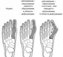 Cum de a vindeca un os la picior: neted și sănătos picior