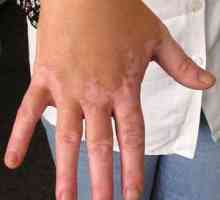 Cum de a vindeca vitiligo, folosind metode conservatoare de tratament