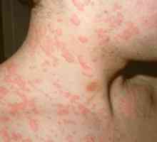 Ce paraziti pot cauza alergii la om