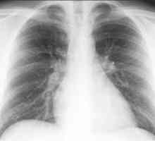 Care sunt primele semne ale bronșitei la adulți? Diagnosticul formelor cronice ale bolii.