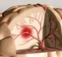 Care sunt semnele precoce si simptome de accident vascular cerebral minor la femei și bărbați?…