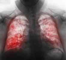Care sunt semnele de pneumonie la copii? Diagnosticul bolii.