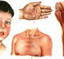 Care sunt simptomele de scarlatină la un copil? Examinarea simptomelor.