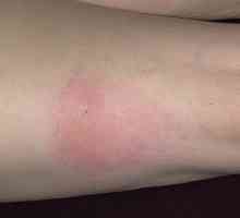 Ce simptome apar atunci când alergii la intepaturi de insecte