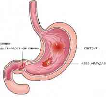 Ulcere Precedată - bulbit stomac superficiale