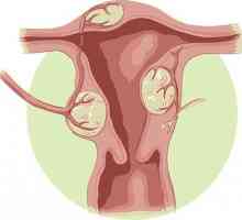 Care sunt simptomele de fibrom uterin?