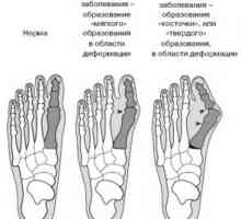 Care este tratamentul hallux valgus deget de la picior mare? Diagnosticul bolii.