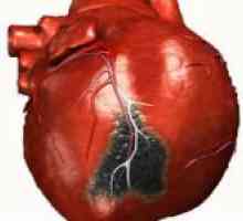 Șoc cardiogen