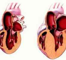 Cardiomiopatie