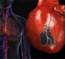Infarct miocardic și tratamentul său