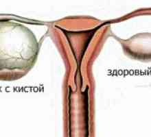Chisturile ovariene: De ce acolo si acolo? Luați în considerare toate cauzele posibile