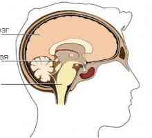 Chist epifiză (glanda pineala) creier