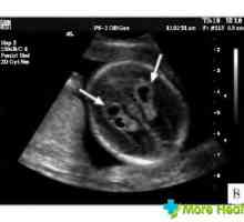 Chist plexul vascular al fatului pe ultrasunete