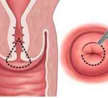 Clasificarea și tratamentul chisturilor pe colul uterin