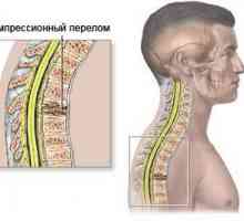 Fractură de comprimare vertebrală
