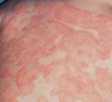 Dermatite: clasificare, diagnostic și tratament