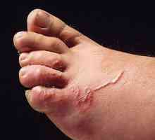 Toxocarioza pielii - un simptom al bolii si tratamentul