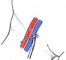 Crossectomy (operațiune Troyanova-Trendelenburg): indicații, conduită, reabilitare