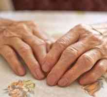 Tratamentul articulațiilor mâinilor artritei