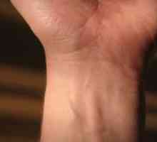 Tratamentul osteoartritei articulației încheietura mâinii