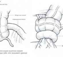 Tratamentul și o operație de necroză intestinală