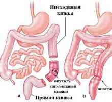 Tratamentul de polipi de colon sigmoid