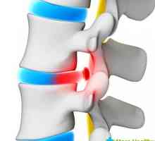 Tratamentul herniei spinării