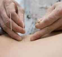 Tratamentul cu acupunctura