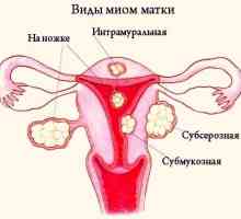 Tratamentul fibrom uterin submucos