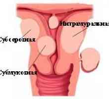 Tratamentul subseros de fibrom uterin